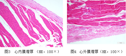 巧克力囊肿不手术直接供卵做借卵代怀试管二代代生试管医生看大小和CA125水平