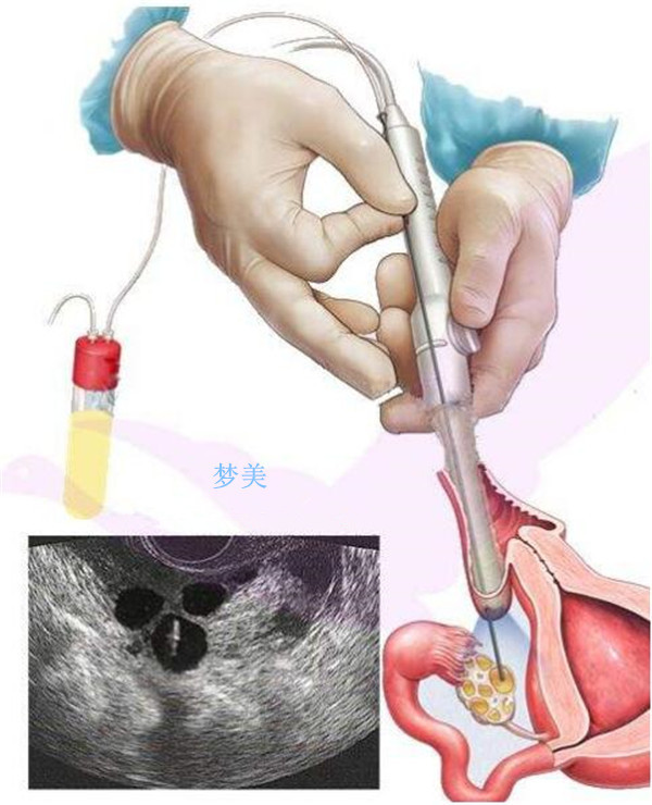 南通供卵为什么成功率高